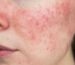 Rosácea en piel madura: claves para un cuidado eficaz con cosmética natural