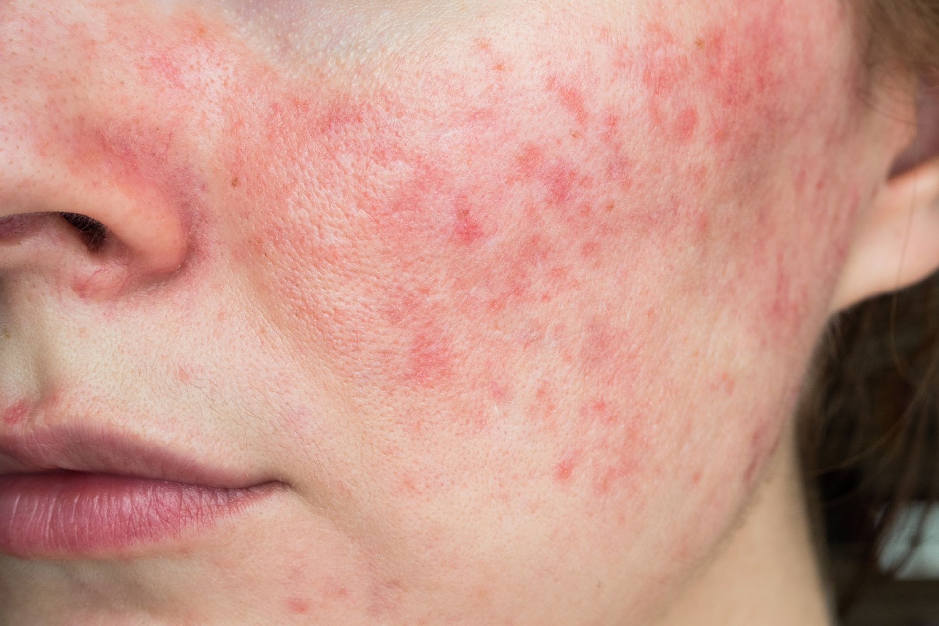Rosácea en piel madura: claves para un cuidado eficaz con cosmética natural